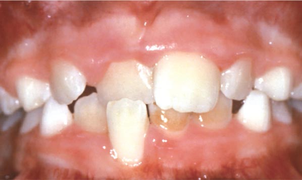 anterior crossbite