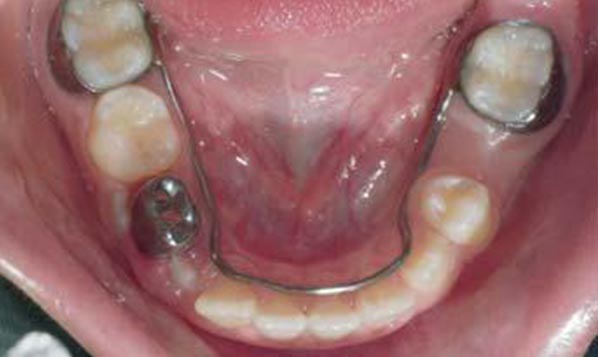 baby teeth loss