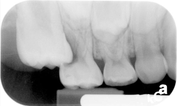 irregularly erupting teeth