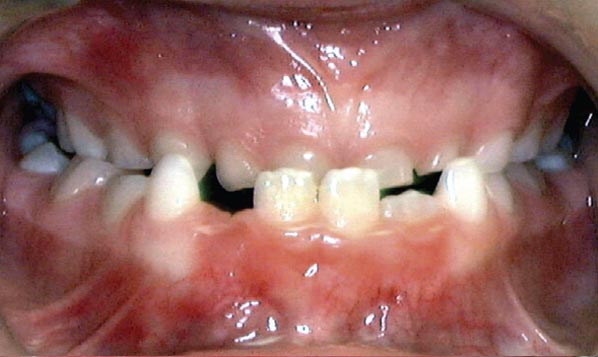 underbite